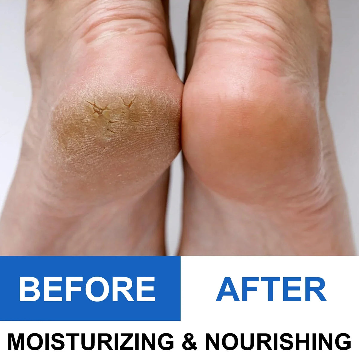 Cracked Heel Repair Stick — Fast Relief for Dry, Painful Heels